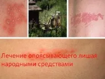 Лікування оперізувального лишаю народними засобами лікування
