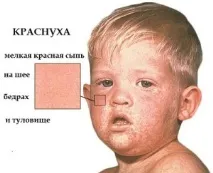 Симптоми та ознаки краснухи у дітей - поради та рекомендації лікарів ознаки