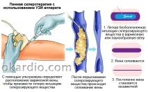 Як лікувати варикоз на ногах у жінок, симптоми та ознаки лікувати