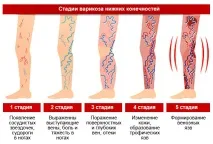 Як лікувати варикоз на ногах у жінок, симптоми та ознаки лікувати