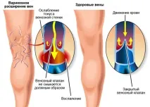 Як лікувати варикоз на ногах у жінок, симптоми та ознаки варикоз