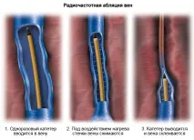 Як лікувати варикоз на ногах у жінок, симптоми та ознаки лікувати