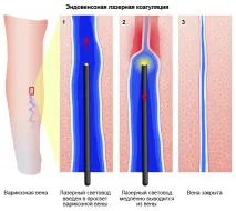 Як лікувати варикоз на ногах у жінок, симптоми та ознаки жінок