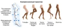 Як лікувати варикоз на ногах у жінок, симптоми та ознаки жінок