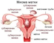 Міоматозний вузол на передній стінці матки вузол