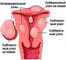 Міоматозний вузол на передній стінці матки передній
