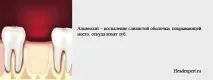 Чи може від зуба боліти голова після видалення зуба