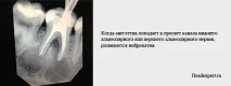 Чи може від зуба боліти голова після видалення боліти
