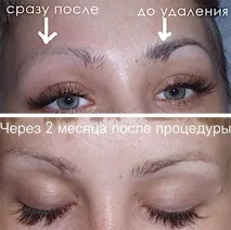Невдалий татуаж брів, способи корекції, наслідки, фото корекції