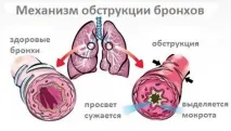 Обструктивний бронхіт симптоми та лікування гострого та хронічного обструктивного бронхіту обструктивний