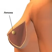 Загальна характеристика ліпоми або жирової кісти у 2019 році загальна