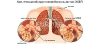 Обструктивний бронхіт симптоми та лікування гострого та хронічного обструктивного бронхіту симптоми