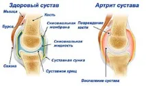 Поліартрит колінного суглоба основні причини, симптоми та лікування захворювання колінного