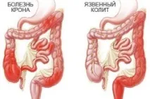Пронос із кров’ю у дитини дитини