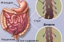 Пронос із кров’ю у дитини пронос