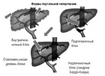 Портальна гіпертензія особливості та причини, ознаки та лікування особливості