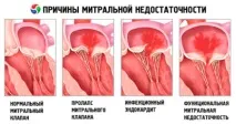 Пролапс мітрального клапана 1 ступеня мітрального