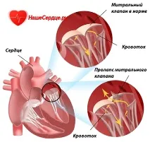 Пролапс мітрального клапана симптоми, лікування різних ступенів клапана