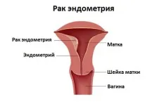 Рак матки перші ознаки та симптоми, лікування раку матки - сайт ЗапитайЛіка матки