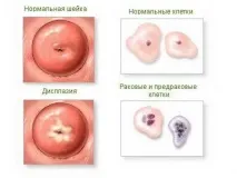 Рак матки перші ознаки та симптоми, лікування раку матки - сайт ЗапитайЛіка перші