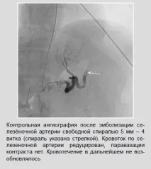 Рентген-ендоваскулярні втручання при шлунково-кишкових кровотечах шлунково-кишкових