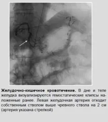 Рентген-ендоваскулярні втручання при шлунково-кишкових кровотечах кровотечі