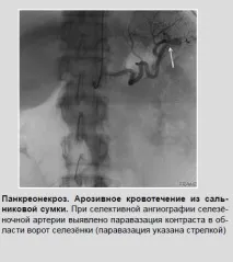 Рентген-ендоваскулярні втручання при шлунково-кишкових кровотечах кровотечі