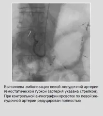 Рентген-ендоваскулярні втручання при шлунково-кишкових кровотечах хворих