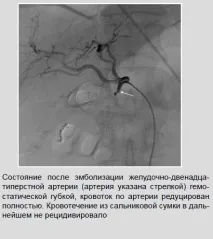 Рентген-ендоваскулярні втручання при шлунково-кишкових кровотечах рентген-ендоваскулярні