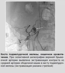 Рентген-ендоваскулярні втручання при шлунково-кишкових кровотечах хворих