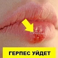 Симптоми вітрянки у дітей до 3 та дорослих лікування дітей