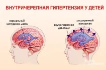 Синдром внутрішньочерепної гіпертензії – ознаки, симптоми, лікування синдром