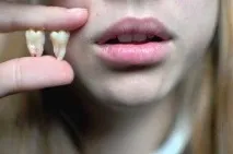 Скільки коренів у зуба мудрості і як вінвиглядає коренів