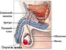 простатит