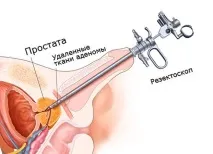 трансуретрална