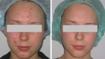 Угри (акне) лікування у Києві, Одесі, ціна на лікування вугрової хвороби (вугрової висипки) вартість, акне