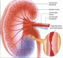 Вузликовий періартеріїт причини, симптоми та лікування хвороби Куссмауля-Майєра симптоми