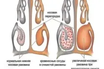 Хронічний риносинусит симптоми та лікування хронічний