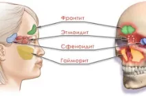 Хронічний риносинусит симптоми та лікування симптоми