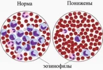 Аналіз крові на еозинофіли - норма, розшифровка еозинофіли