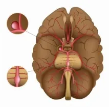 аневризма