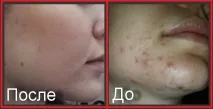 Болтушка від прищів рецепт дерматолога | рецепт
