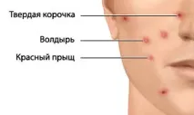 Болтушка від прищів рецепт дерматолога | дерматолога