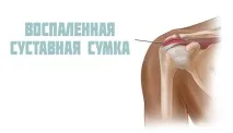 Бурсит плечового суглоба бурсит