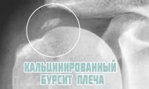 Бурсит плечового суглоба бурсит