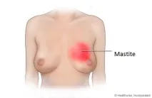 Що таке мастит лікування та профілактика мастит