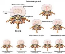 Що таке протрузія дисків хребта види, діагностика, лікування діагностика