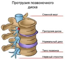 Що таке протрузія дисків хребта види, діагностика, лікування хребта