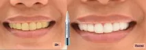 Олівець Luxury White Pro – голівудська посмішка простіше простого! Відгуки, ціни, спосіб застосування luxury