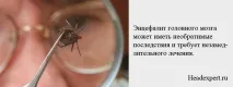 Енцефаліт головного мозку, що це таке, симптоми, причини, лікування симптоми